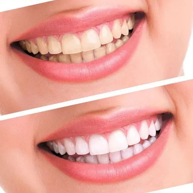 CleanBright™ Şarjlı Diş Beyazlatma Kiti